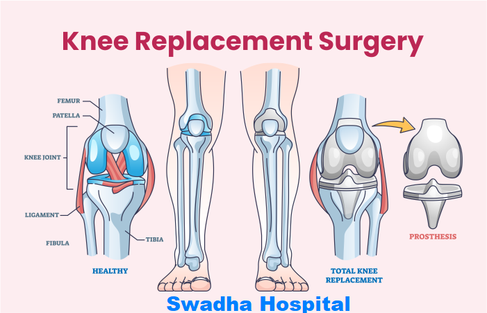 knee replacement surgery